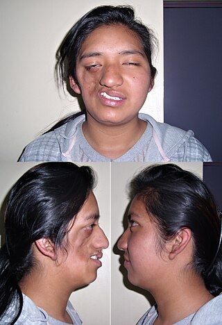 <span class="mw-page-title-main">Parry–Romberg syndrome</span> Rare disease involving degeneration of tissues beneath the skin