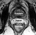 Prostate spacer.jpg