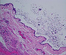 Dilated rete testis containing spermatozoa within cyst lumen. H&E stain 20x Spermato20x.jpg