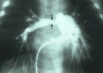 Thumbnail for Pulmonary artery stenosis