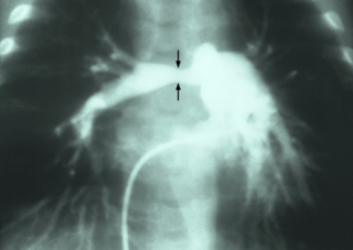 <span class="mw-page-title-main">Pulmonary artery stenosis</span> Medical condition