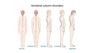 Kyphosis (at far right) in comparison with other vertebral column disorders, including scoliosis and lordosis Vertebral column disorders - Normal Scoliosis Lordosis Kyphosis -- Smart-Servier.jpg
