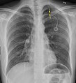 X-ray subtle pneumothorax in inspiration - annotated.jpg