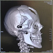 3D human skull from computed tomography data 12-06-11-rechtsmedizin-berlin-07.jpg