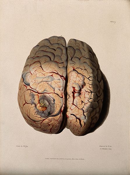 File:A diseased brain. Coloured stipple etching by W. Say after F Wellcome V0009789.jpg