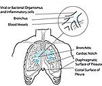 Bronchitis diagram