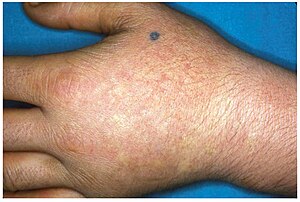 Lupus Symptoms - Photosensitivity – Skin Care