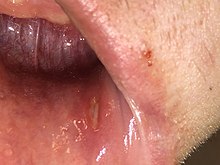 Ulcers can take many shapes and sizes. This one is long and narrow Aphthous Stomatitis in the mouth.jpg