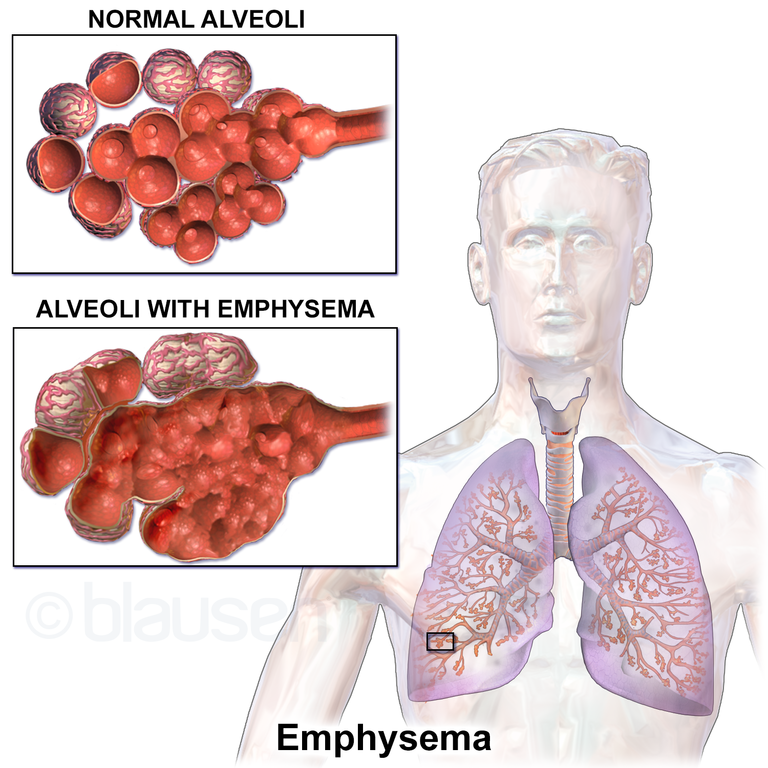 copd diagnose stellen