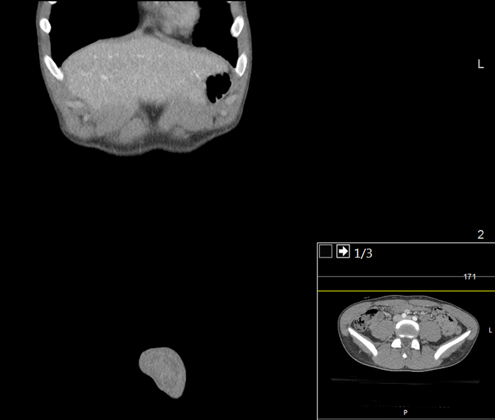 CT of a normal abdomen and pelvis, coronal plane 21.png