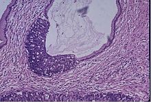 Microscope image of the cervical gland showing an area of high grade epithelial dysplasia. Ca in situ, cervix.jpg