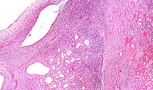 Cystic nephroma low mag.jpg