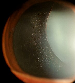 Ectopia lentis disorder of lens