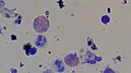 Eosinophils in Giemsa stained slit skin smear.jpg