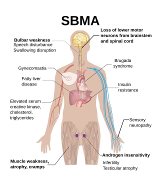 <span class="mw-page-title-main">Spinal and bulbar muscular atrophy</span> Medical condition