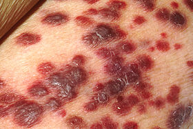 Kaposi's sarcoma on the skin of an AIDS patient