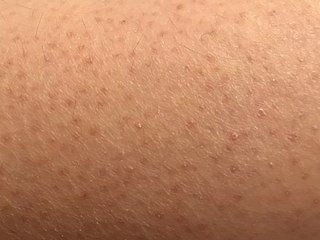 Keratosis pilaris Skin condition characterized by small bumps caused by overproduction of keratin