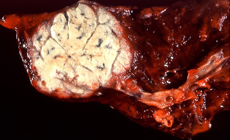 File:Metastatic colonic adenocarcinoma (5616503603).jpg