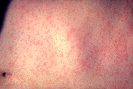 Morbillivirus measles infection