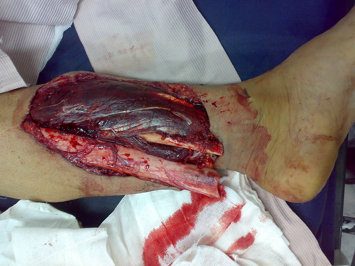 File:Short leg cast.jpg - Wikipedia