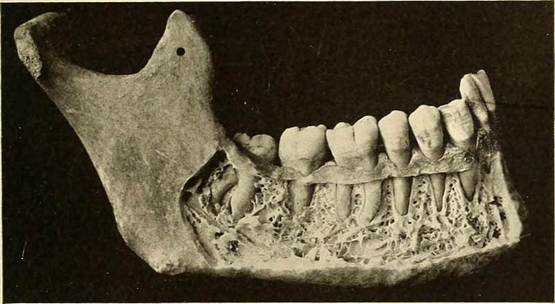 File:Oral Roentgenology - a Roentgen study of the anatomy and pathology of the oral cavity (1917) (14757789055).jpg