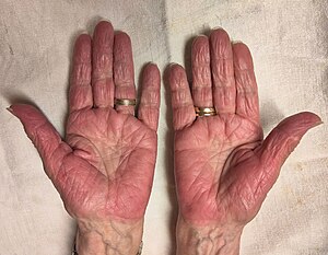 Palmar erythema.jpg