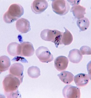 Verschiedene Formen von Plasmodium falciparum im gefärbten Blutausstrich