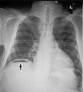 Miniatura per Pneumoperitoneo