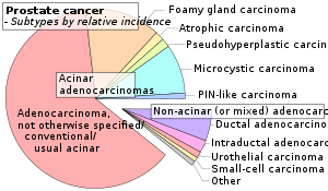 prostate cancer types of cells