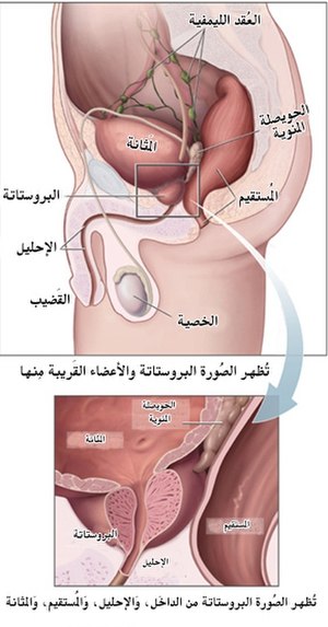 سرطان البروستاتا: الأعراض, الأسباب, الميكانيكية (الآلية) المرضية