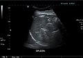 Spleen seen on abdominal ultrasonography