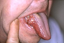 cancer epidermoide bucal faley curăță corpul de paraziți