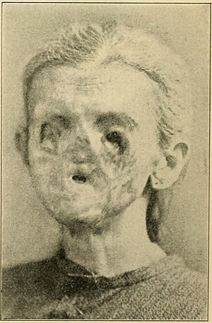 Closure of mouth from congenital syphilis.jpg