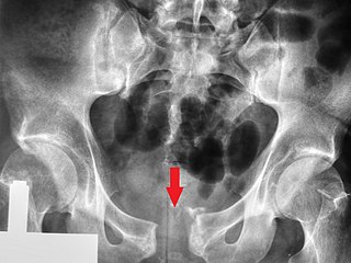 <span class="mw-page-title-main">Pelvic fracture</span> Broken bone in nonacetabular portions of pelvis