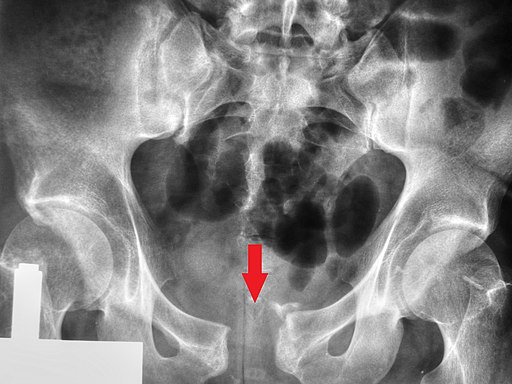 Diastasis symphysis pubis can cause snapping hip syndrome