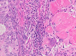 Endometrial endometrioid carcinoma with squamous differentiation and keratin granulomas, high magnification.jpg