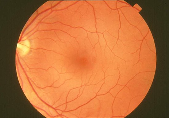 Макулопатия глаза. Макулярный разрыв сетчатки глаза. Солнечная ретинопатия.