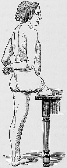 Hemimelia of the right leg (complete absence of leg with foot on hip) Gould Pyle 115.jpg