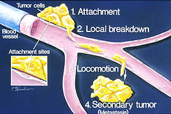 How metastasis occurs illustration.jpg