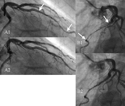 Myocardial bridge