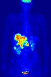 Ganzkörper PET-Aufnahme mit 18F-Fluordesoxyglucose von Lebermetastasen eines Enddarmtumors