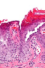 Thumbnail for Transient acantholytic dermatosis