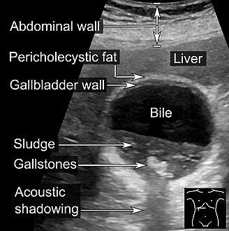 Biliary sludge and gallstones. There is borderline thickening of the gallbladder wall.