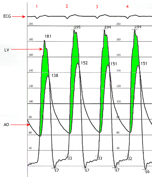 File:Aortic Stenosis - Hemodynamic Pressure Tracing.png