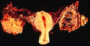 Vorschaubild für Ovarialkarzinom