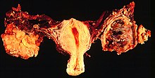 Bilateral ovarian serous carcinomas, gross pathology.jpg