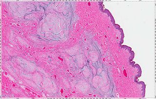 <span class="mw-page-title-main">Cutaneous myxoma</span> Medical condition