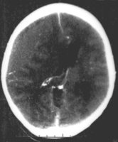 Nontraumatic epidural hematoma in a young woman. The grey area in the top left is organizing hematoma, causing midline shift and compression of the ventricle.