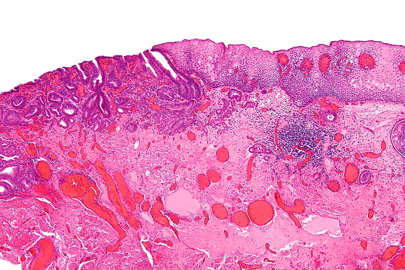 File:Esophageal adenocarcinoma - low mag.jpg