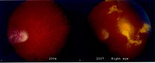 Two circular images of the right eye's retina shown in red. The left picture taken in 2004 shows the normal dark red blood vessels and the image on the right taken in 2007 shows exudate blotches in white